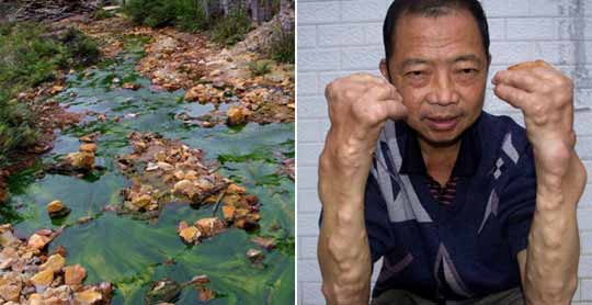 广西村庄重金属污染 村民手脚畸形